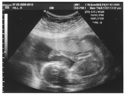 The ultrasound image of Kris Hill's baby girl was taken Thursday.