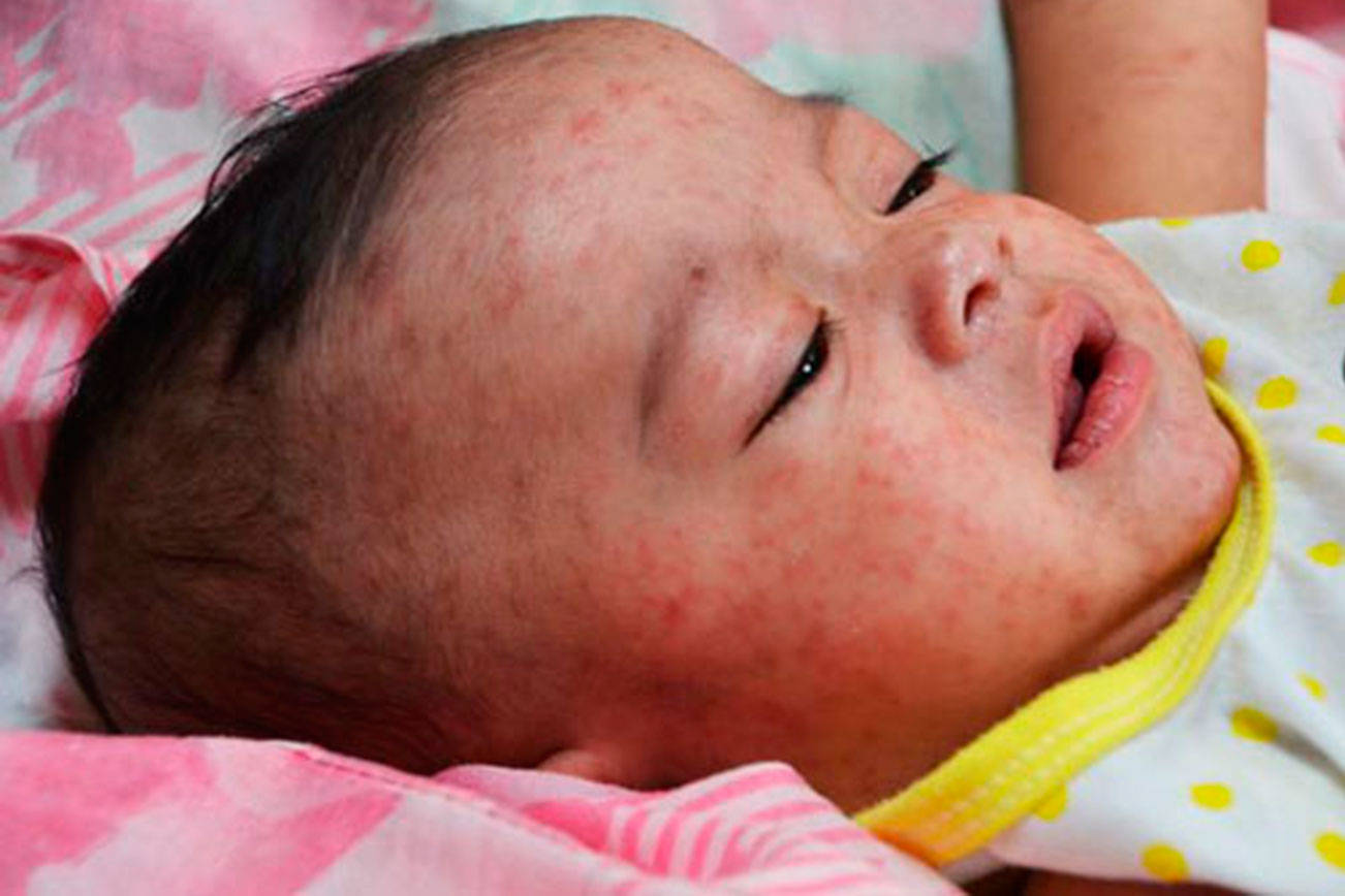 Infant with measles. Photo courtesy of Washington State Department of Health/Centers for Disease Control