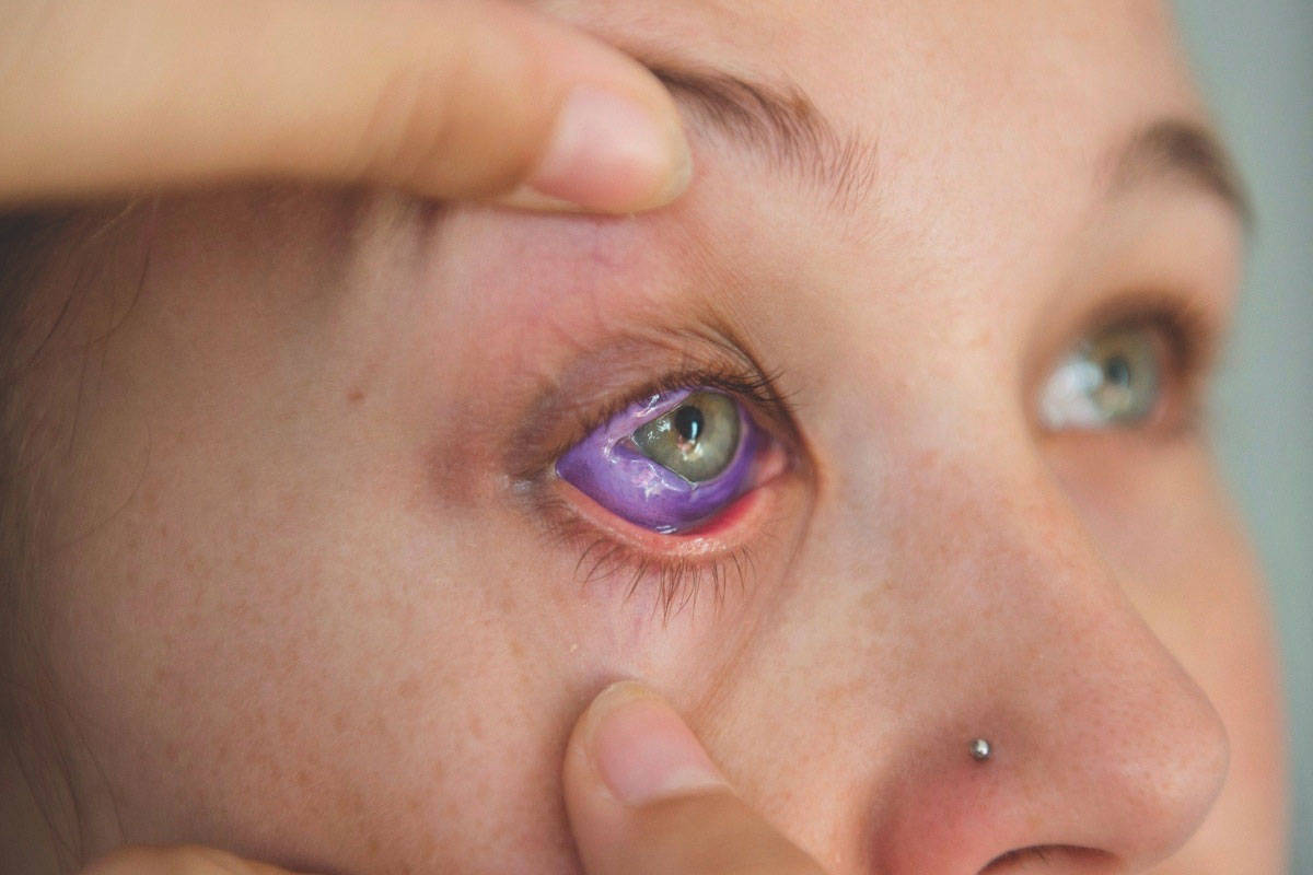 A woman shows a botched ink injection in her eyeball. Photo courtesy of the Canadian Press