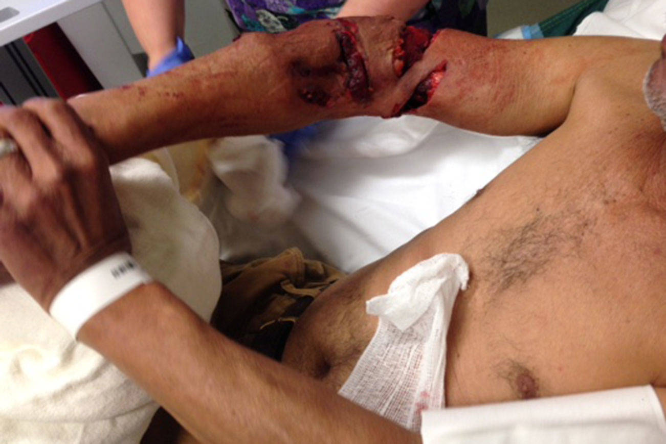 An image of Urbano Velazquez’s arm after he was bitten by a King County Sheriff’s Office K-9. It has been cropped to remove Velazquez’s face. File photo