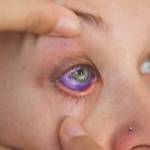 A woman shows a botched ink injection in her eyeball. Photo courtesy of the Canadian Press